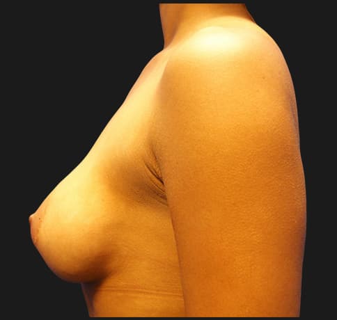 Case 8396, Performed By Dr. Tehrani – angle 4 After