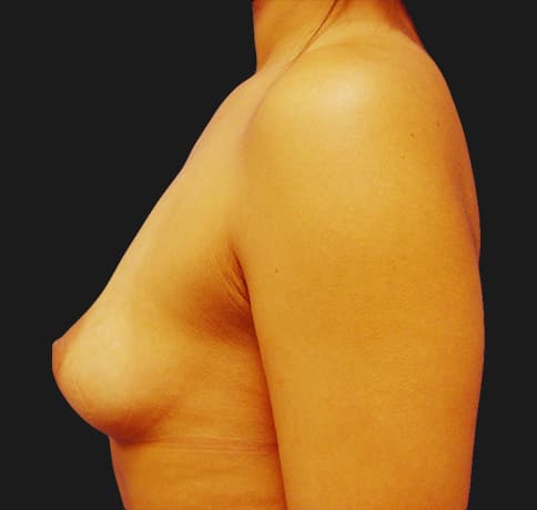 Case 8396, Performed By Dr. Tehrani – angle 4 Before