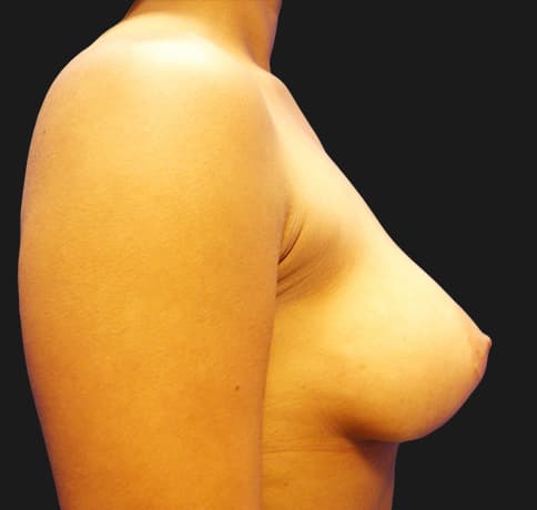 Case 8396, Performed By Dr. Tehrani – angle 5 After