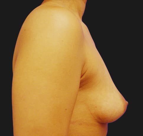 Case 8396, Performed By Dr. Tehrani – angle 5 Before