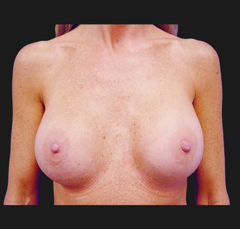 Case 7104, Performed By Dr. Tehrani – After