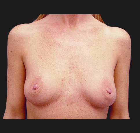 Case 7104, Performed By Dr. Tehrani – Before