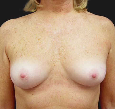 Case 2475, Performed By Dr. Tehrani – Before