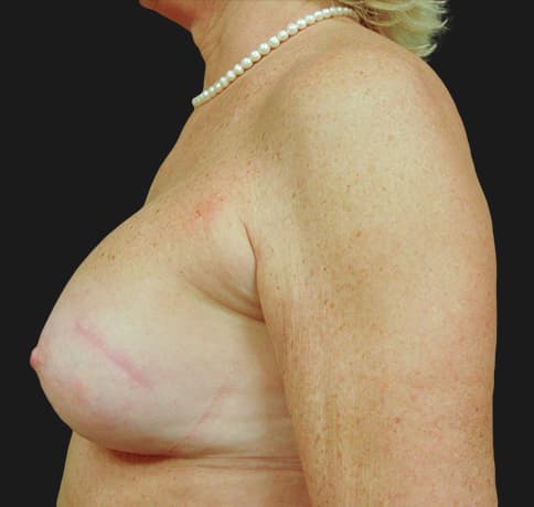 Case 2475, Performed By Dr. Tehrani – angle 3 After