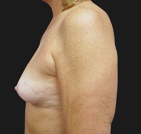 Case 2475, Performed By Dr. Tehrani – angle 3 Before