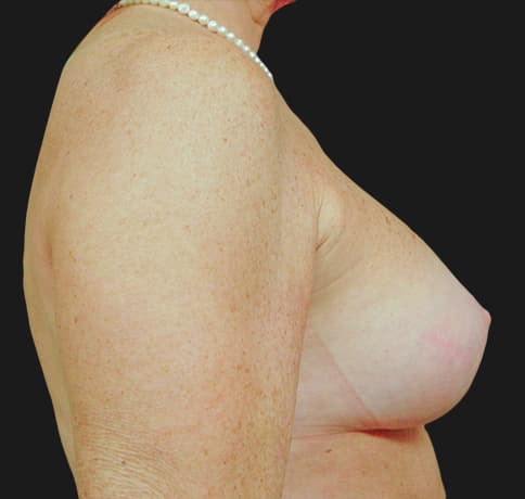 Case 2475, Performed By Dr. Tehrani – angle 2 After