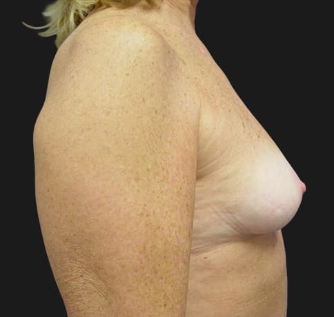 Case 2475, Performed By Dr. Tehrani – angle 2 Before