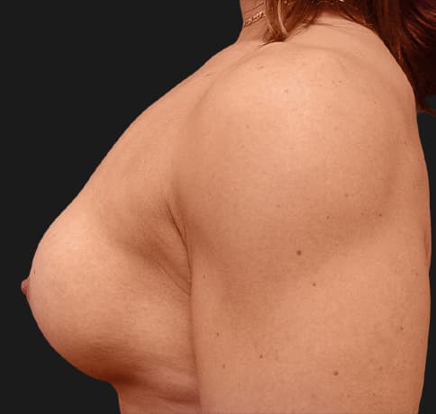 Case 9398, Performed By Dr. Tehrani – angle 4 After