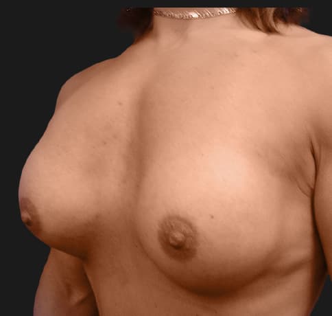 Case 9398, Performed By Dr. Tehrani – angle 3 After