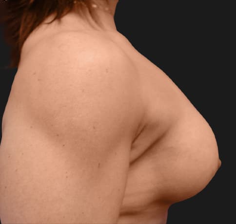 Case 9398, Performed By Dr. Tehrani – angle 5 After