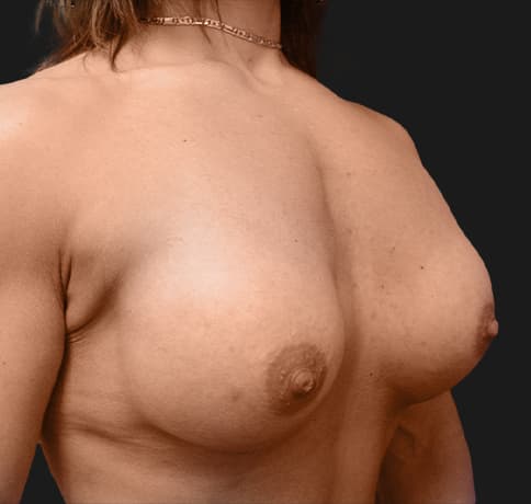 Case 9398, Performed By Dr. Tehrani – angle 2 After