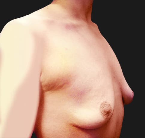 Case 9443, Performed By Dr. Tehrani – angle 2 Before