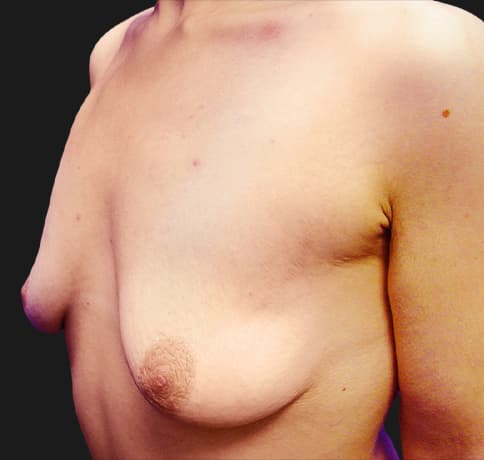 Case 9443, Performed By Dr. Tehrani – angle 3 Before