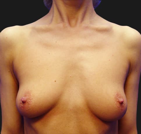 Case 8612, Performed By Dr. Tehrani – Before