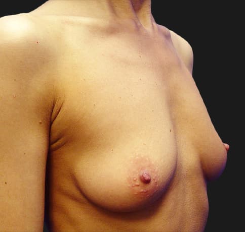 Case 8612, Performed By Dr. Tehrani – angle 2 Before