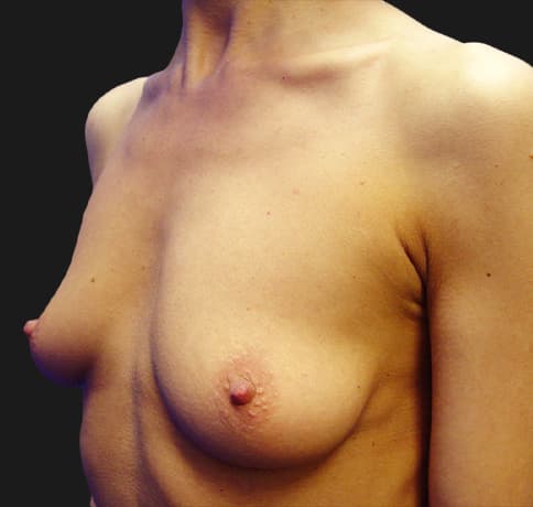 Case 8612, Performed By Dr. Tehrani – angle 3 Before