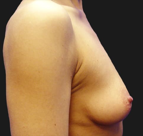 Case 8612, Performed By Dr. Tehrani – angle 4 Before