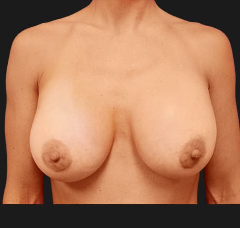 Case 7489, Performed By Dr. Tehrani – After