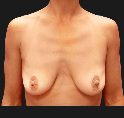 Case 7489, Performed By Dr. Tehrani – Before