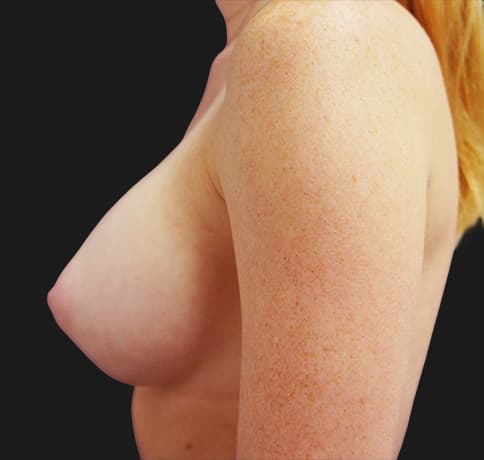 Case 20709, Performed By Dr. Tehrani – angle 4 After