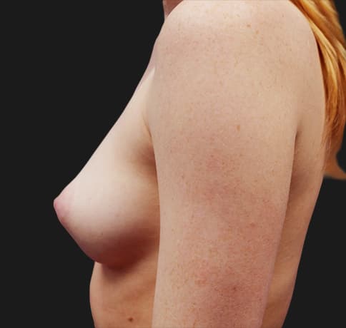 Case 20709, Performed By Dr. Tehrani – angle 4 Before