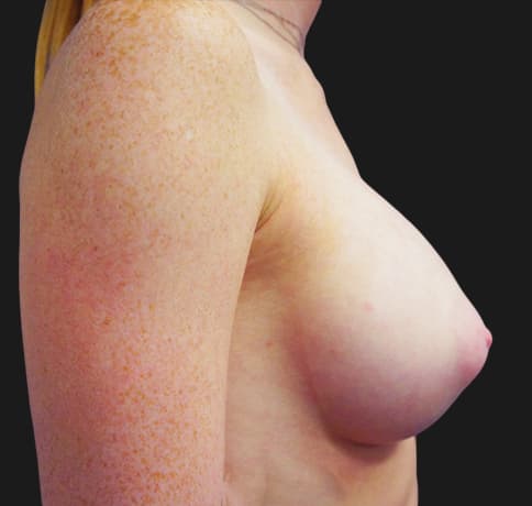Case 20709, Performed By Dr. Tehrani – angle 5 After