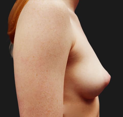 Case 20709, Performed By Dr. Tehrani – angle 5 Before