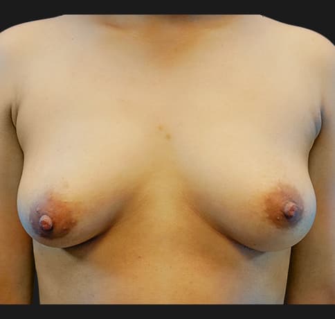 Case 16605, Performed By Dr. Tehrani – Before