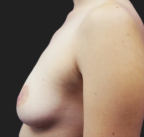 Case 20924, Performed By Dr. Tehrani – angle 4 Before