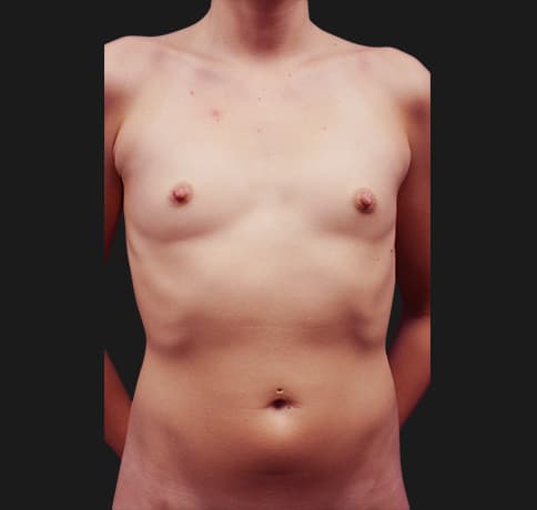 Case 20958, Performed By Dr. Tehrani – angle 5 Before