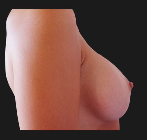 Case 20958, Performed By Dr. Tehrani – angle 4 After