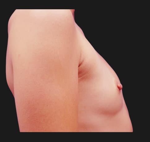 Case 20958, Performed By Dr. Tehrani – angle 4 Before
