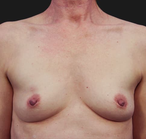 Case 22472, Performed By Dr. Tehrani – Before