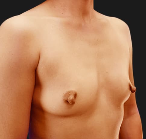 Case 1000, Performed By Dr. Tehrani – angle 2 Before