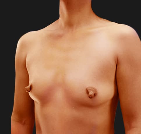 Case 1000, Performed By Dr. Tehrani – angle 3 Before