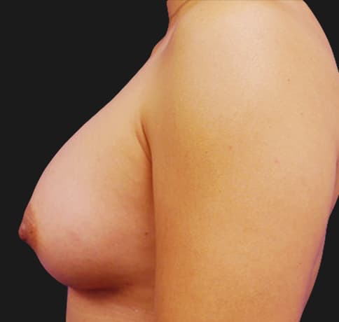 Case 1000, Performed By Dr. Tehrani – angle 4 After