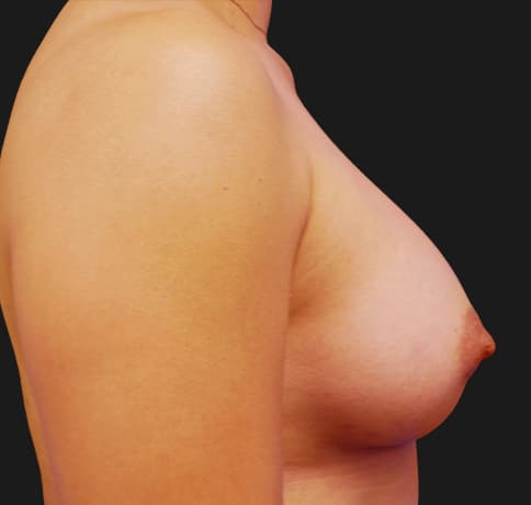Case 1000, Performed By Dr. Tehrani – angle 5 After