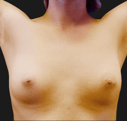 Case 19360, Performed By Dr. Tehrani – angle 3 Before