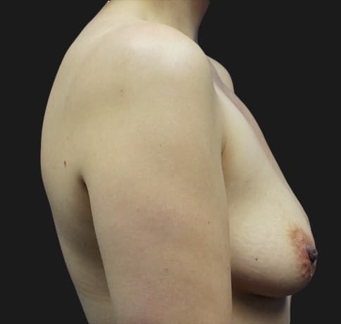 Case 21908, Performed By Dr. Tehrani – angle 4 Before