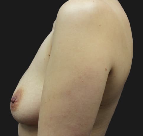 Case 21908, Performed By Dr. Tehrani – angle 5 Before