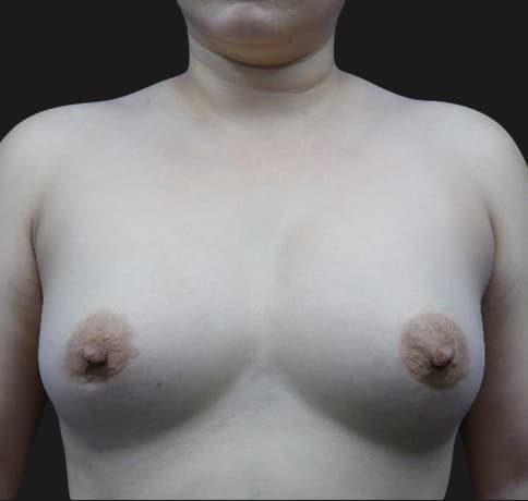 Case 34819, Performed By Dr. Tehrani – Before