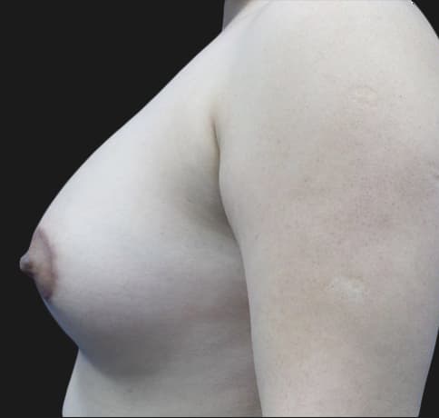 Case 34819, Performed By Dr. Tehrani – angle 3 After