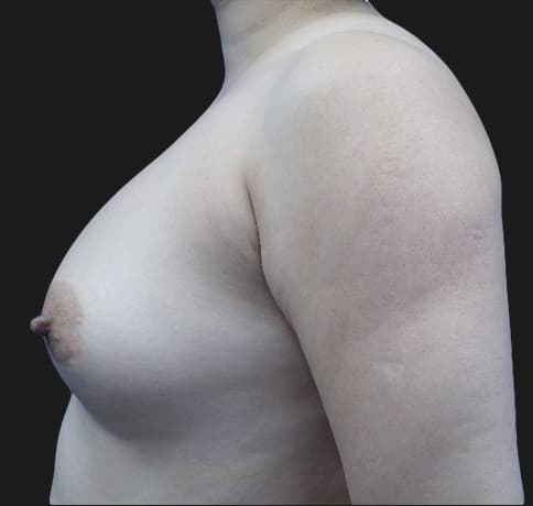 Case 34819, Performed By Dr. Tehrani – angle 3 Before