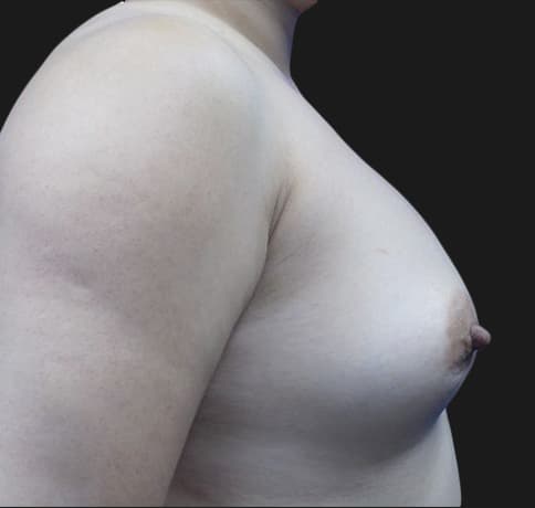 Case 34819, Performed By Dr. Tehrani – Before