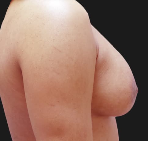Case 31825, Performed By Dr. Tehrani – angle 3 After