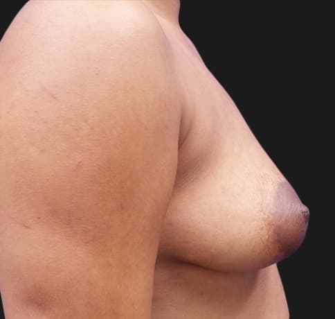 Case 31825, Performed By Dr. Tehrani – angle 3 Before