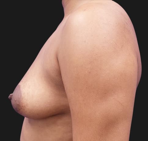 Case 31825, Performed By Dr. Tehrani – angle 4 Before