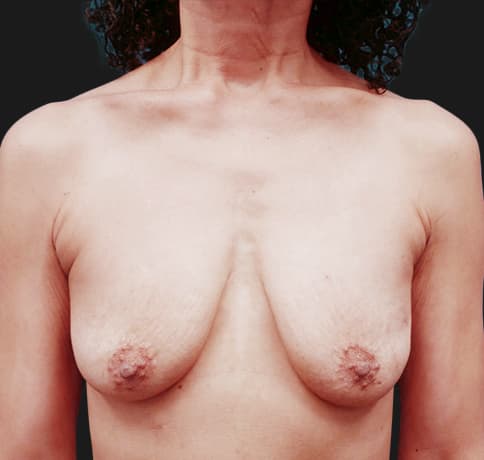Case 23462, Performed By Dr. Tehrani – Before
