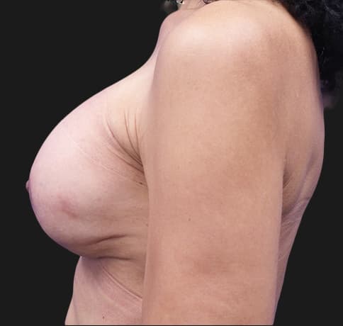 Case 23462, Performed By Dr. Tehrani – angle 3 After