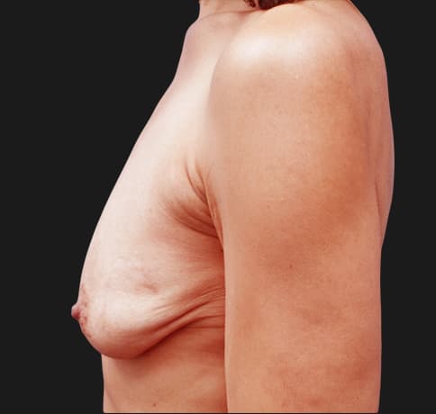 Case 23462, Performed By Dr. Tehrani – angle 3 Before